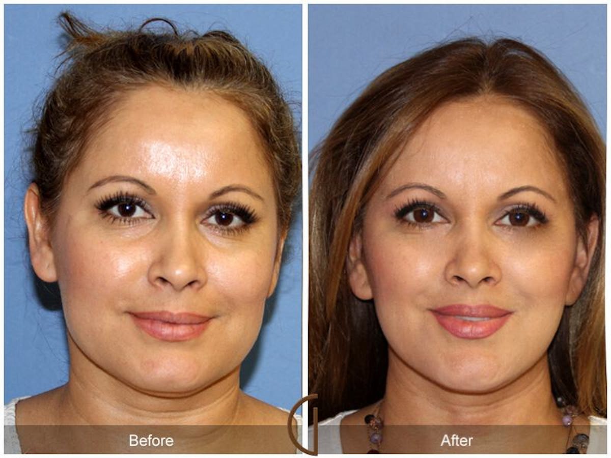 Facelift 40s Before & After Gallery - Patient 382311 - Image 2
