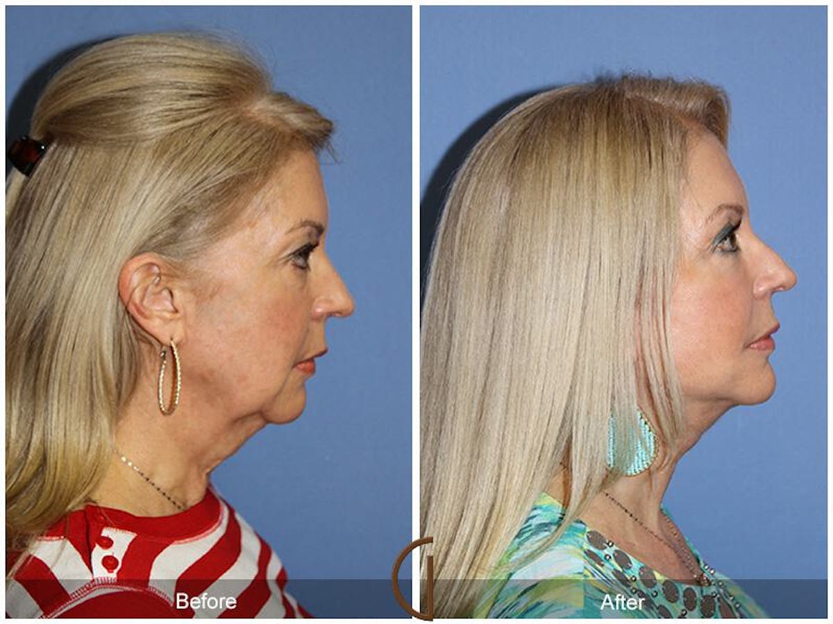 Facelift 60s Before & After Gallery - Patient 379499 - Image 3