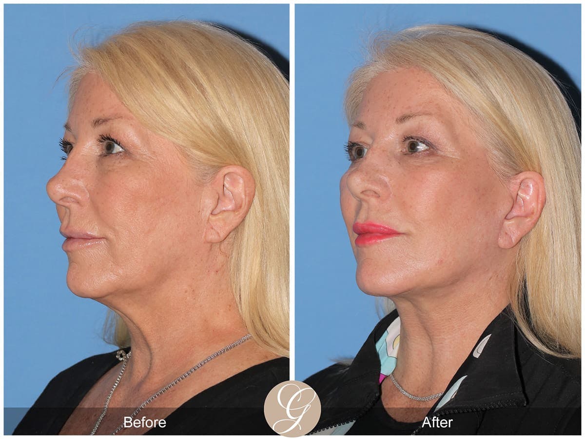 Deep Plane Facelift Before & After Gallery - Patient 147347 - Image 3