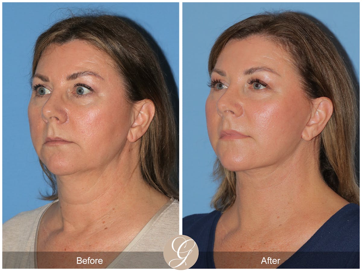 Preservation Facelift Before & After Gallery - Patient 491704 - Image 2