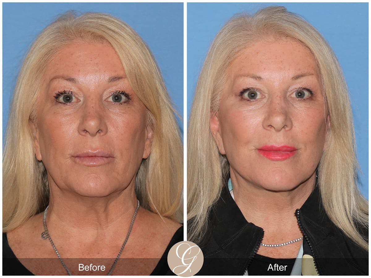 Deep Plane Facelift Before & After Gallery - Patient 147347 - Image 1