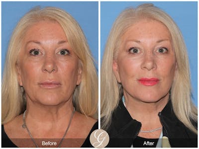 Deep Plane Facelift Before & After Gallery - Patient 147347 - Image 1
