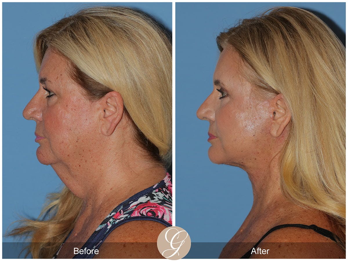 Deep Plane Facelift Before & After Gallery - Patient 426158 - Image 2