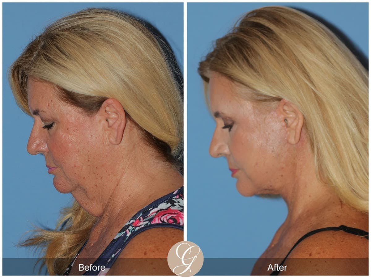 Deep Plane Facelift Before & After Gallery - Patient 426158 - Image 3