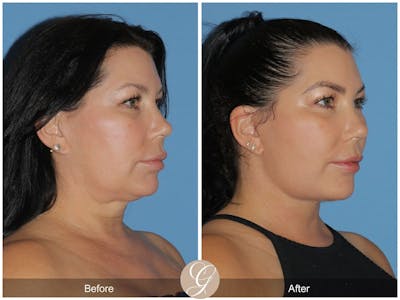 Facelift Before & After Gallery - Patient 259271 - Image 1