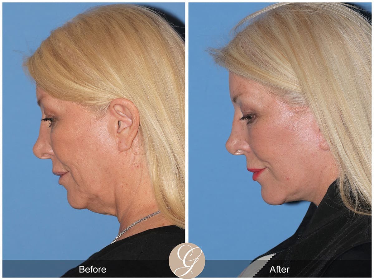 Deep Plane Facelift Before & After Gallery - Patient 147347 - Image 2