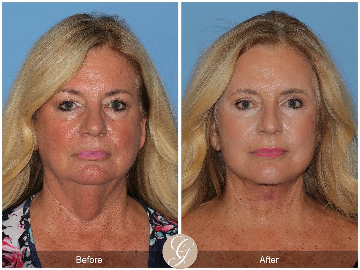 Deep Plane Facelift Before & After Gallery - Patient 426158 - Image 1