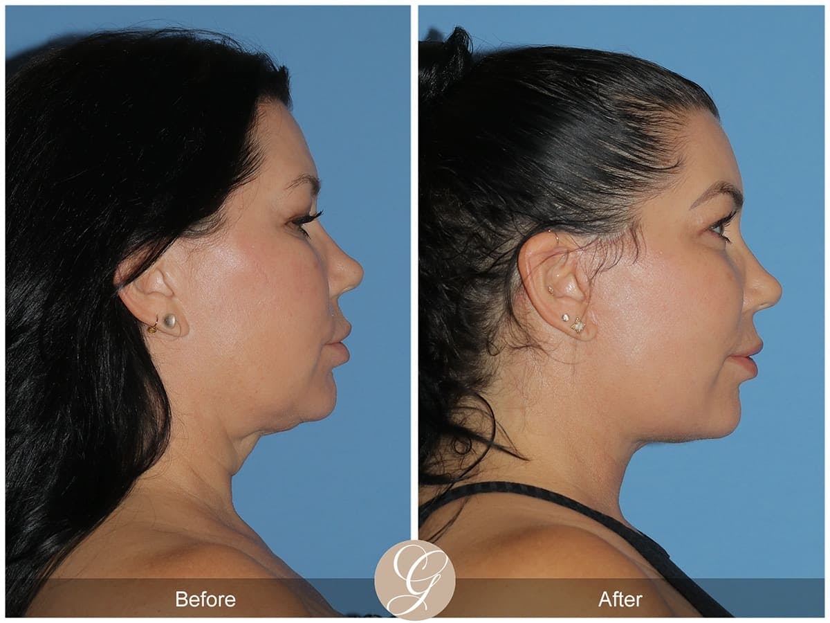 Facelift Before & After Gallery - Patient 259271 - Image 2