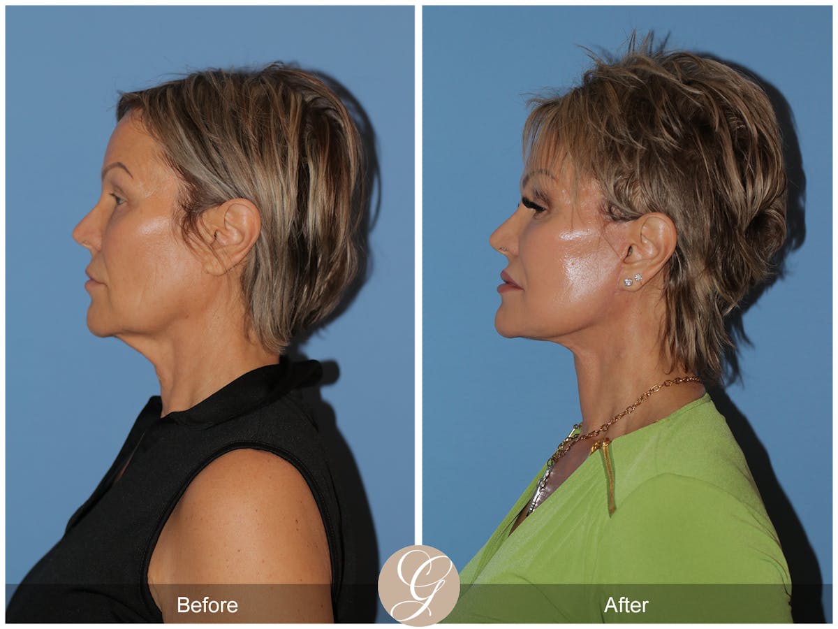 Deep Plane Facelift Before & After Gallery - Patient 117863 - Image 4