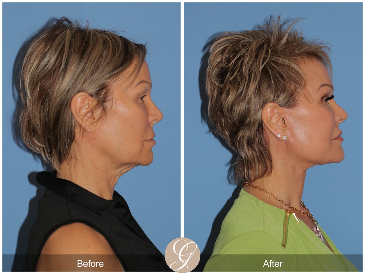 Deep Plane Facelift Before & After Gallery - Patient 117863 - Image 5