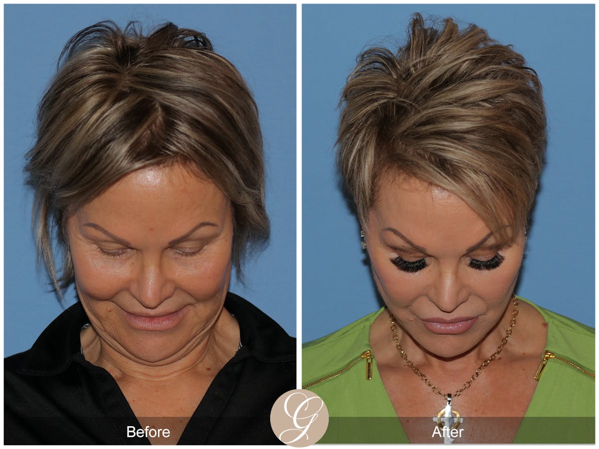 Deep Plane Facelift Before & After Gallery - Patient 117863 - Image 3