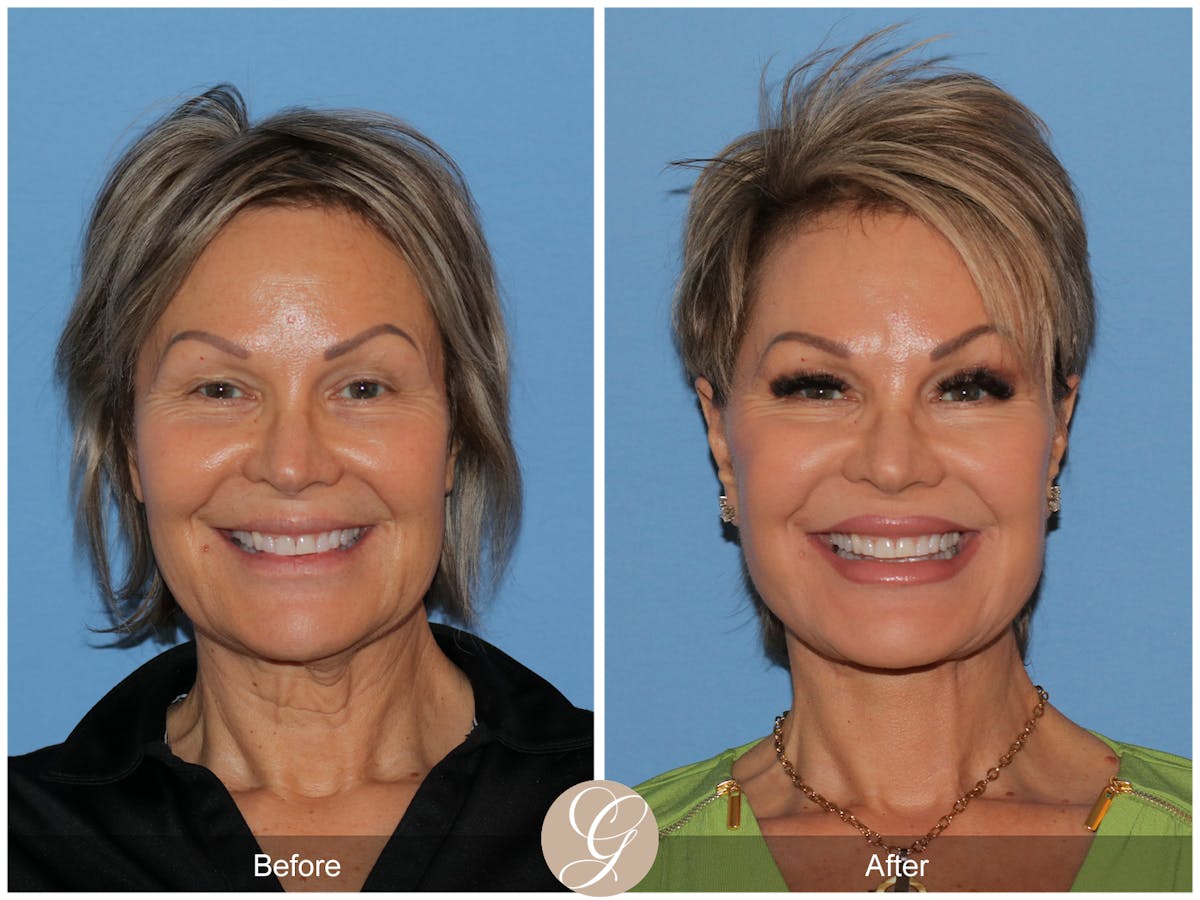 Deep Plane Facelift Before & After Gallery - Patient 117863 - Image 2