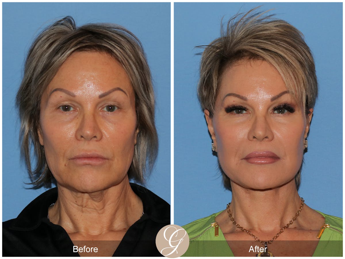 Deep Plane Facelift Before & After Gallery - Patient 117863 - Image 1