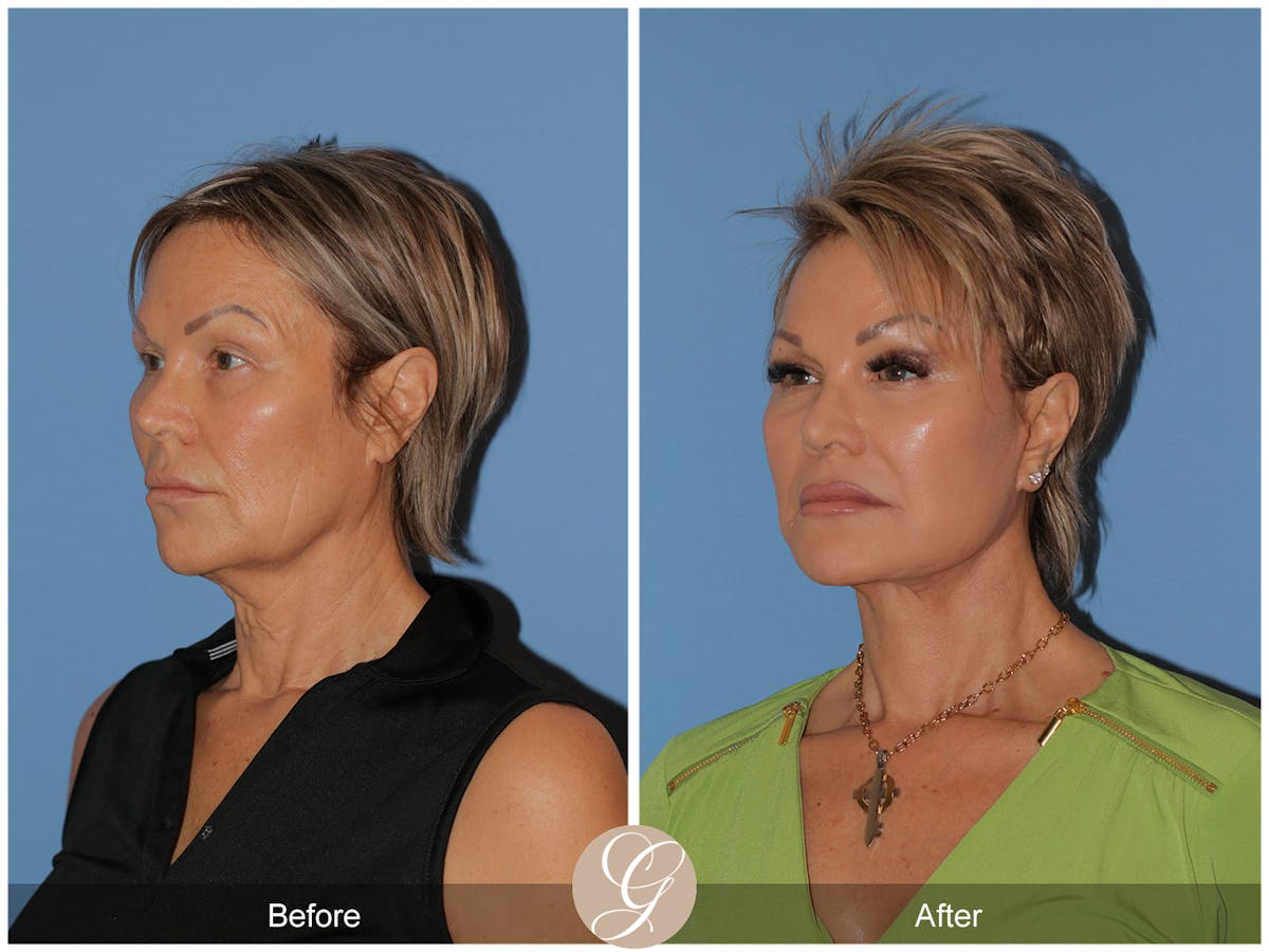 Deep Plane Facelift Before & After Gallery - Patient 117863 - Image 7