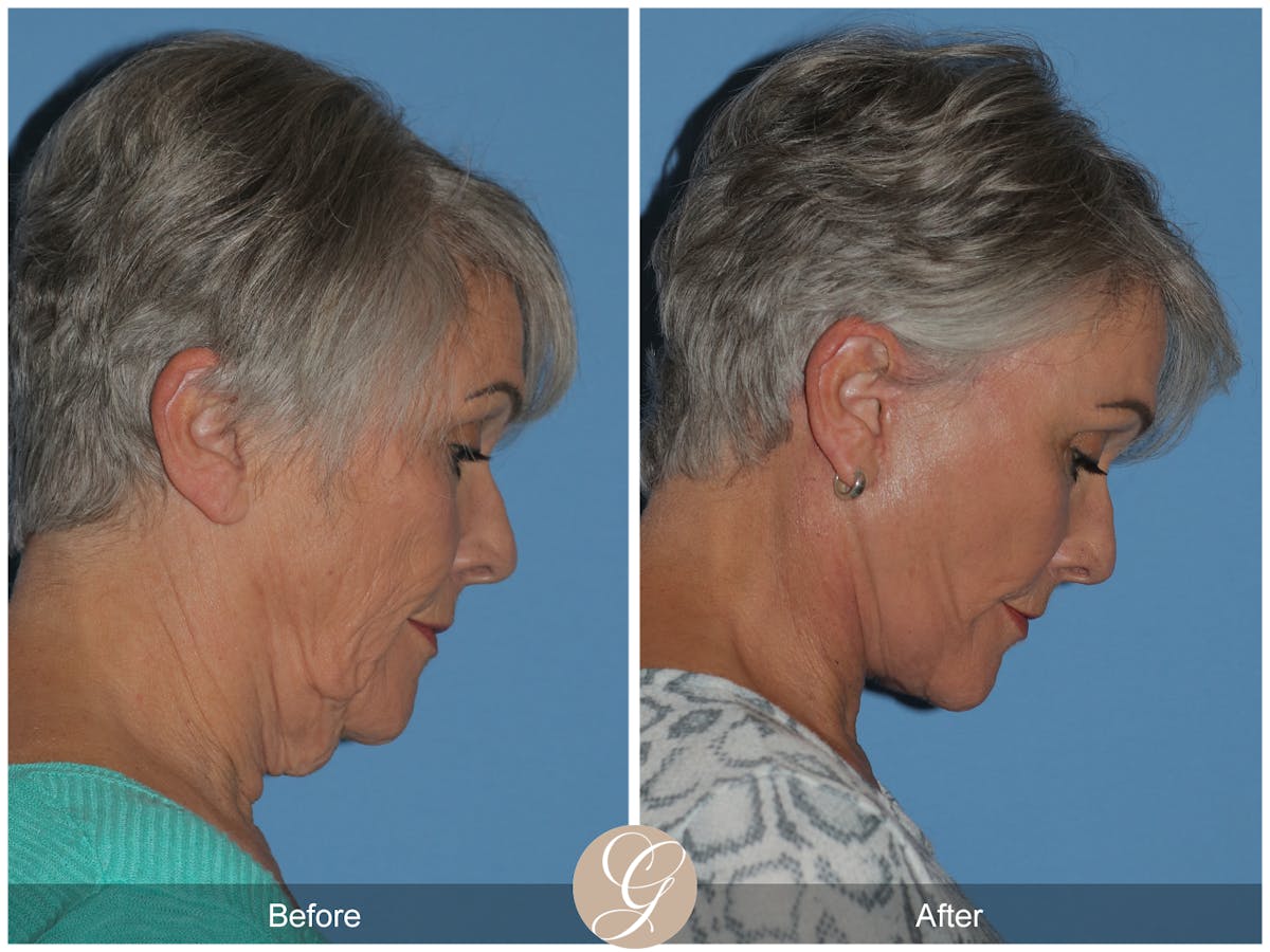 Deep Plane Facelift Before & After Gallery - Patient 309477 - Image 4
