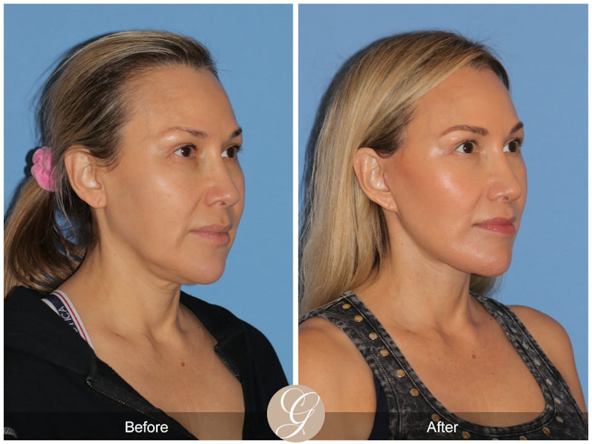 Preservation Facelift Before & After Gallery - Patient 343417 - Image 2