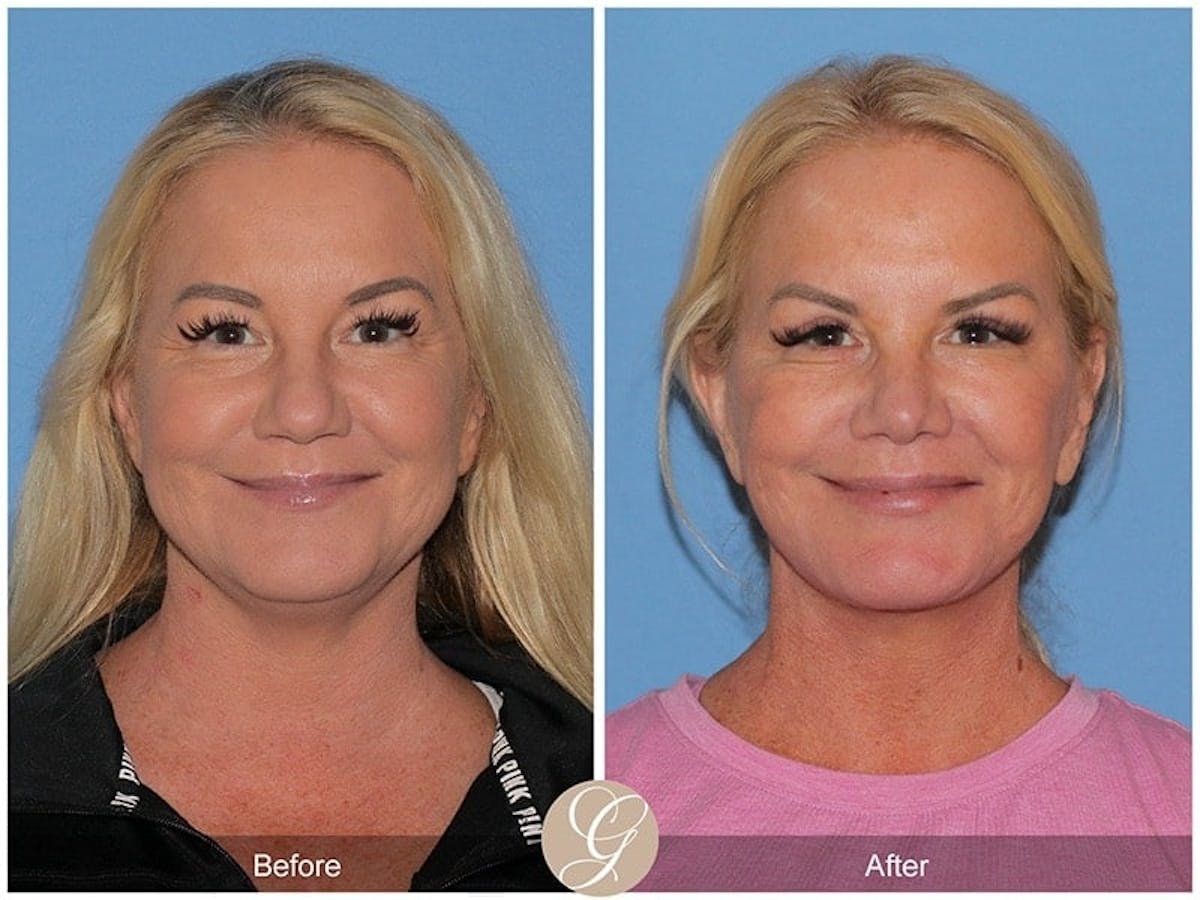 Preservation Facelift Before & After Gallery - Patient 298384 - Image 1