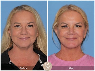 Deep Plane Facelift Before & After Gallery - Patient 301508 - Image 1
