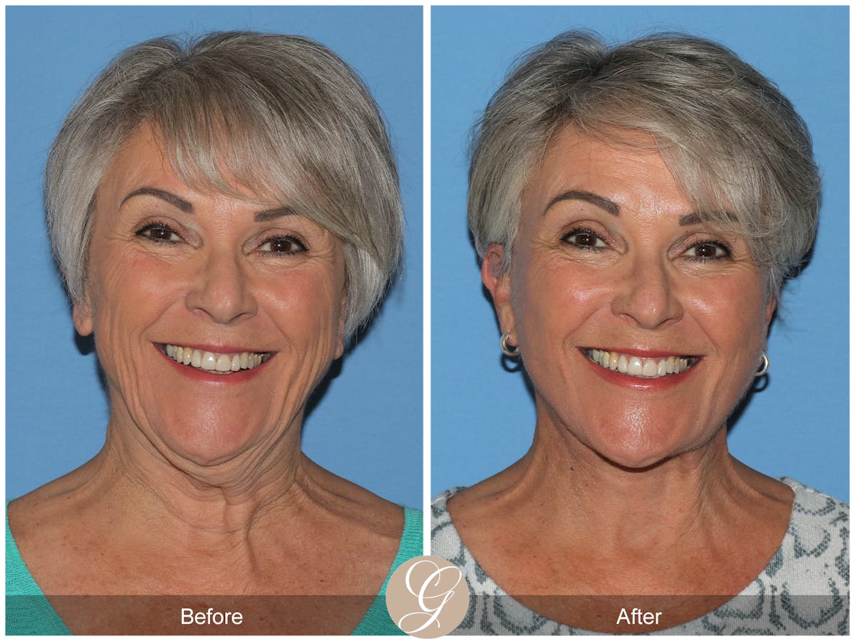 Deep Plane Facelift Before & After Gallery - Patient 309477 - Image 1