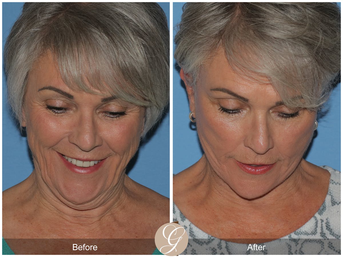 Deep Plane Facelift Before & After Gallery - Patient 309477 - Image 2