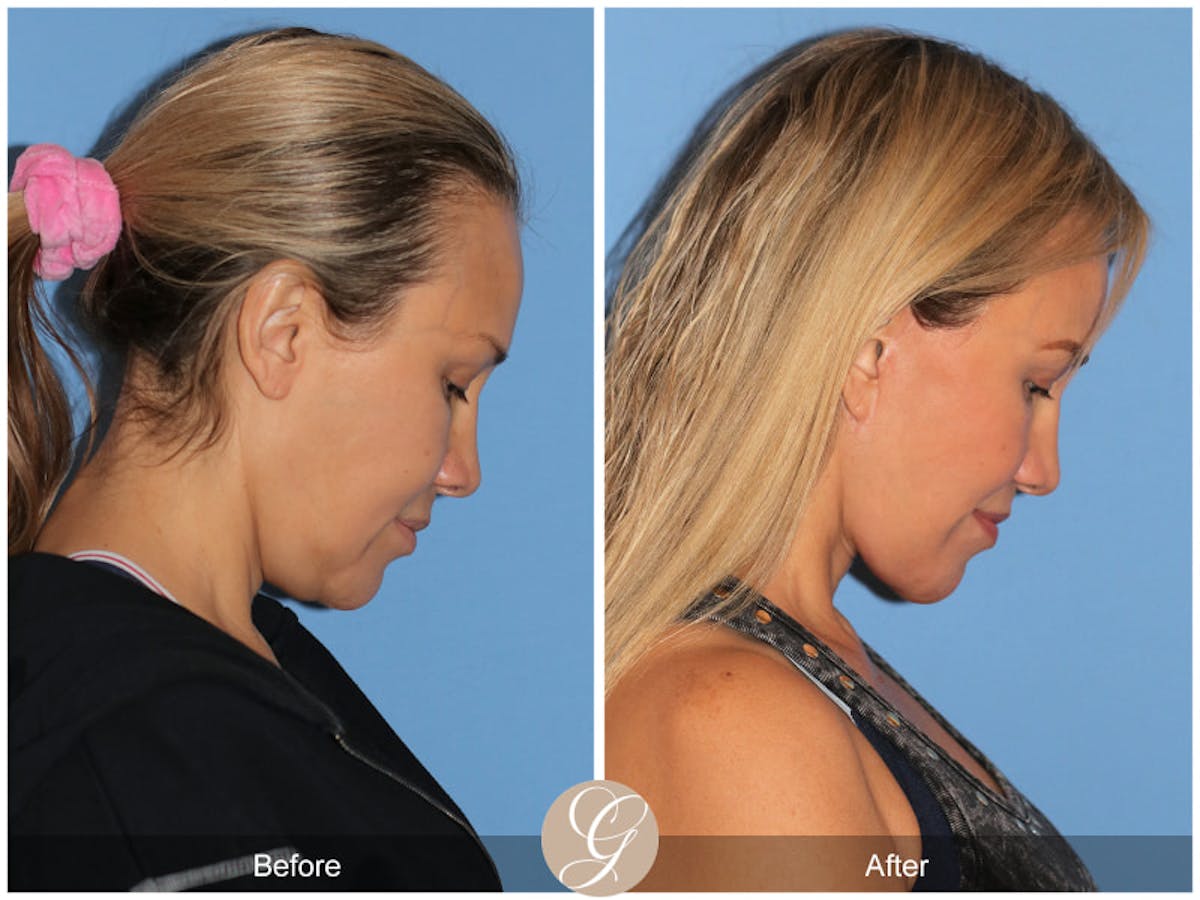 Preservation Facelift Before & After Gallery - Patient 343417 - Image 3
