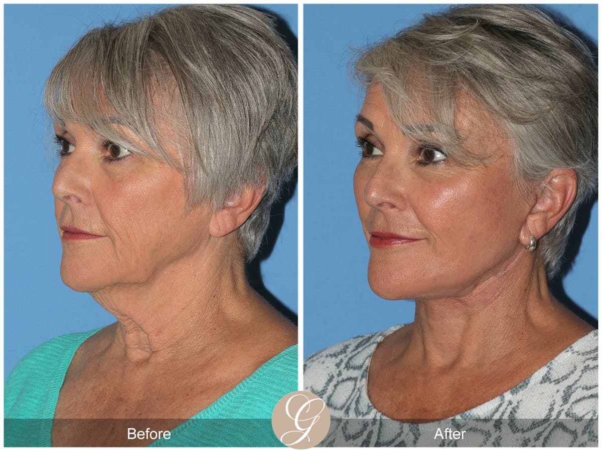 Deep Plane Facelift Before & After Gallery - Patient 309477 - Image 3