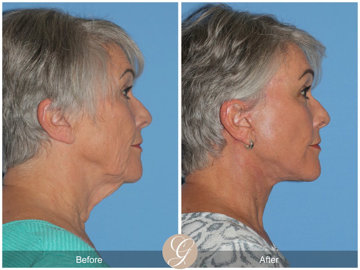 Deep Plane Facelift Before & After Gallery - Patient 309477 - Image 5