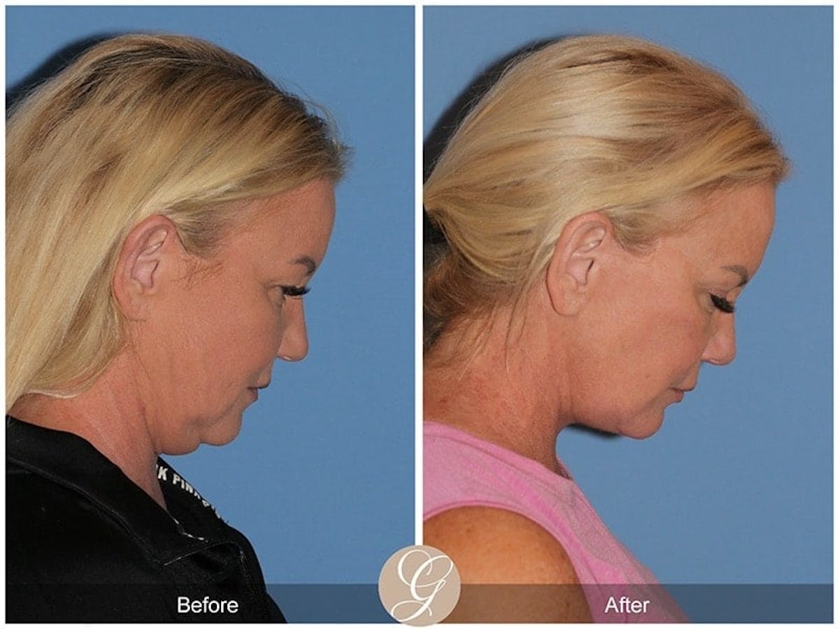 Preservation Facelift Before & After Gallery - Patient 298384 - Image 2