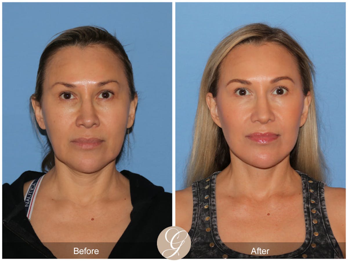 Preservation Facelift Before & After Gallery - Patient 343417 - Image 1