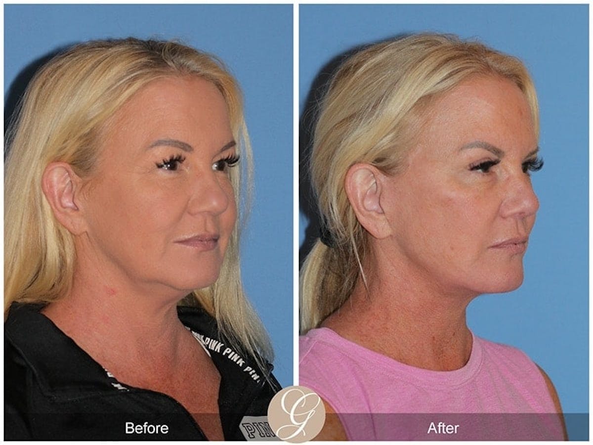Preservation Facelift Before & After Gallery - Patient 298384 - Image 3