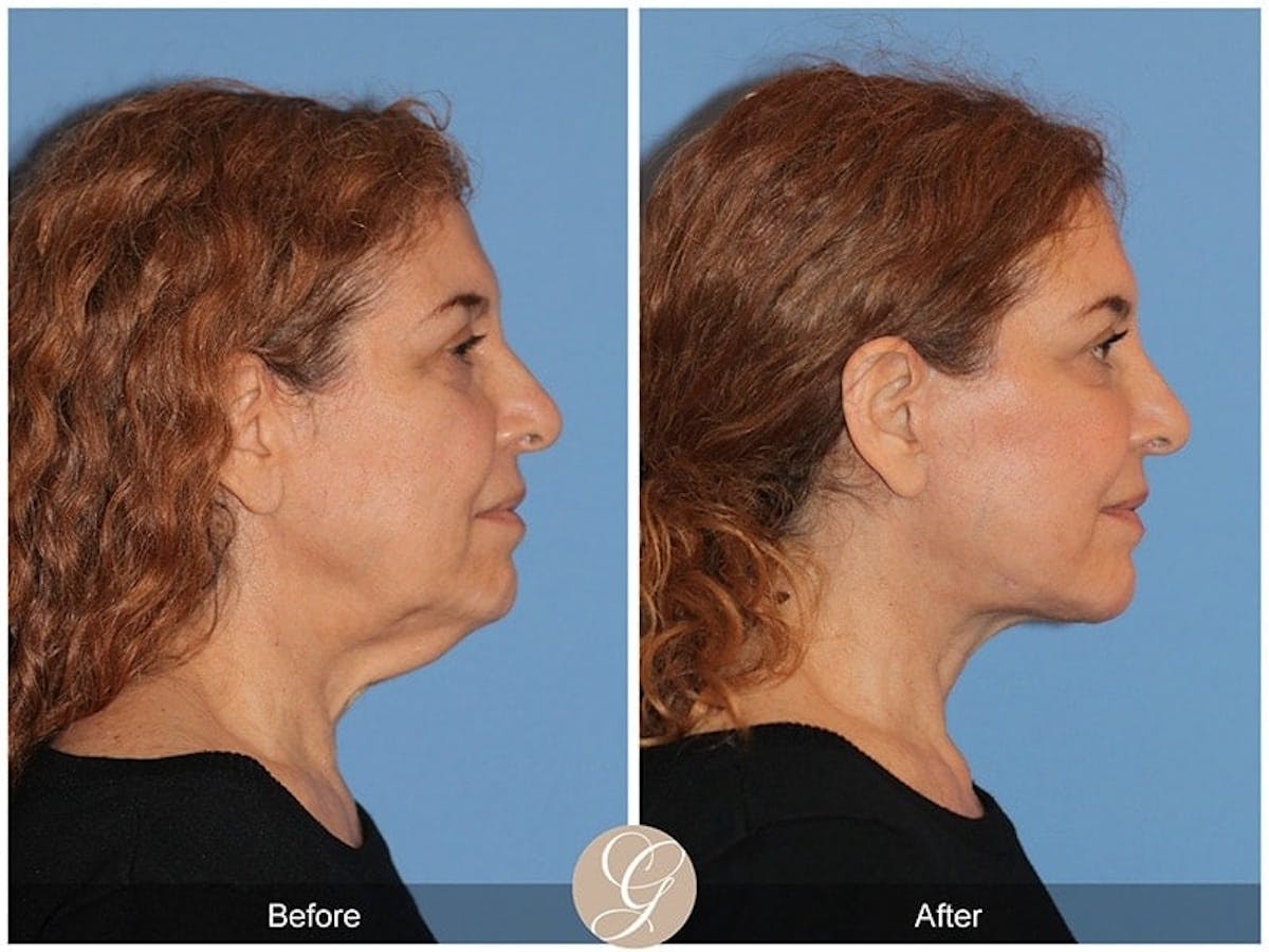 Preservation Facelift Before & After Gallery - Patient 336460 - Image 3