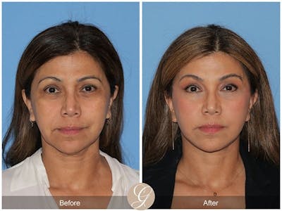 Deep Plane Facelift Before & After Gallery - Patient 345802 - Image 1