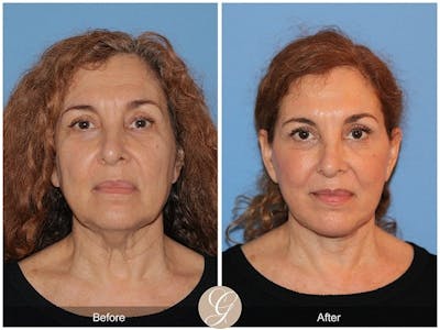 Deep Plane Facelift Before & After Gallery - Patient 266950 - Image 1