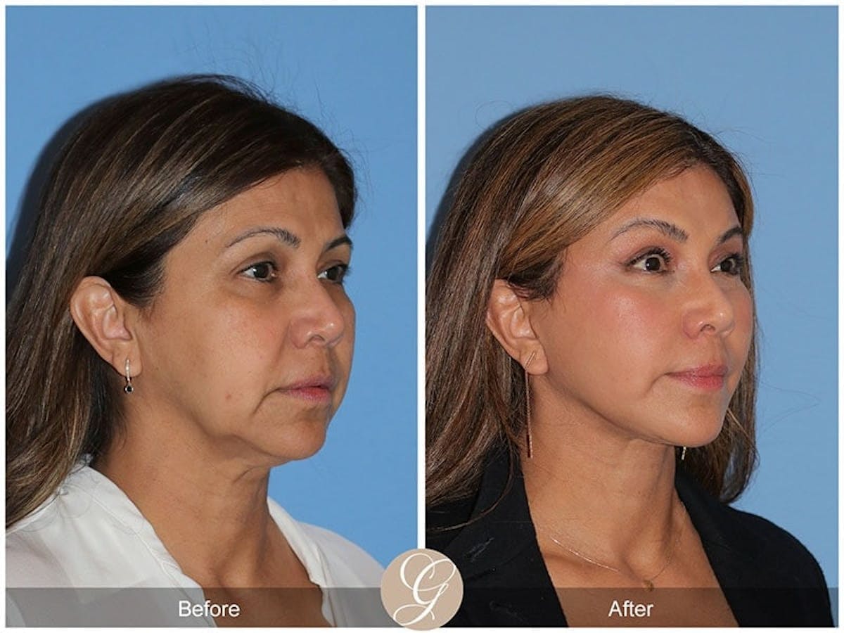 Preservation Facelift Before & After Gallery - Patient 118306 - Image 3