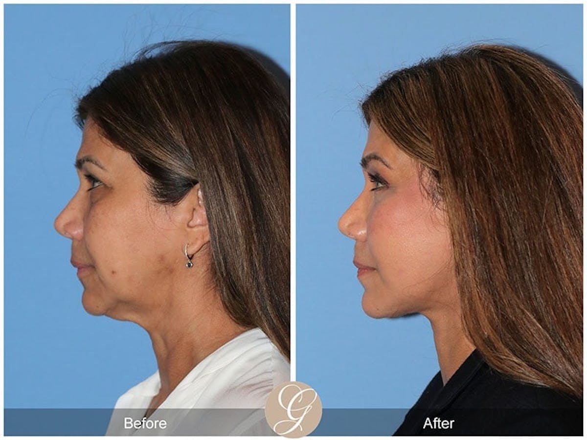 Preservation Facelift Before & After Gallery - Patient 118306 - Image 2