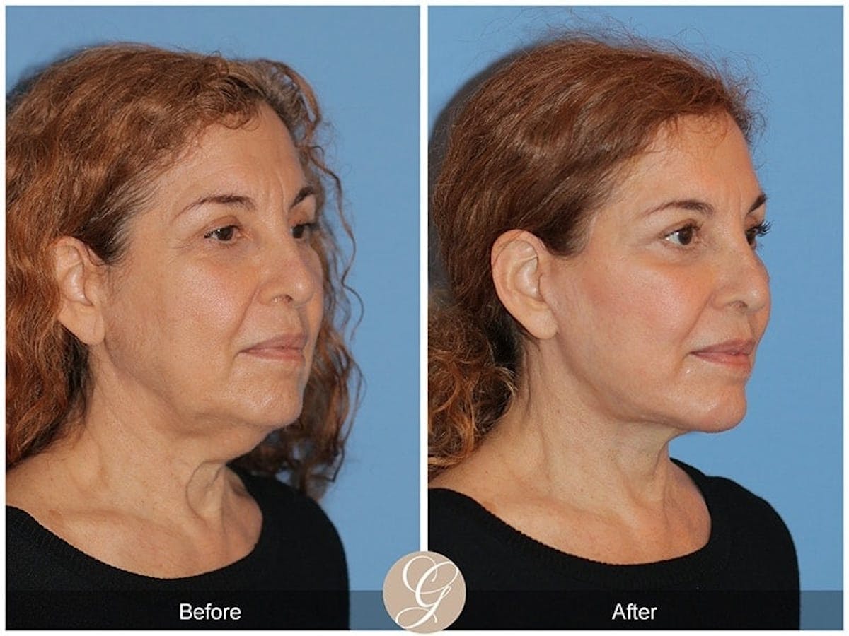 Preservation Facelift Before & After Gallery - Patient 336460 - Image 2