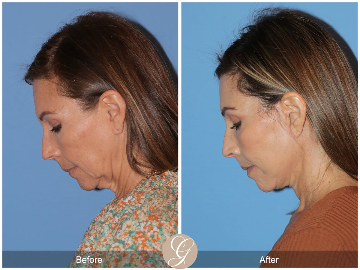 Deep Plane Facelift Before & After Gallery - Patient 136689 - Image 4