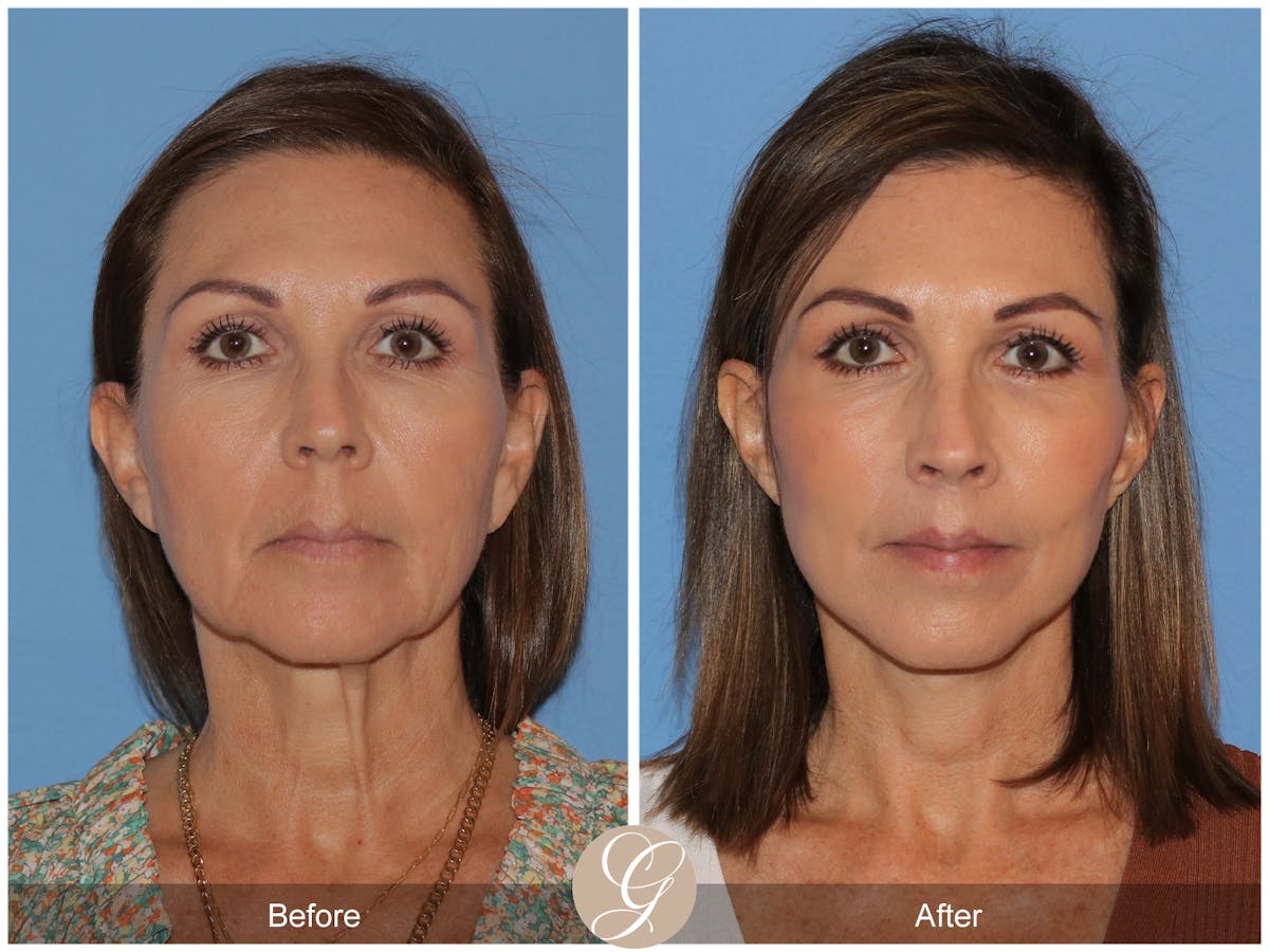 Deep Plane Facelift Before & After Gallery - Patient 136689 - Image 1
