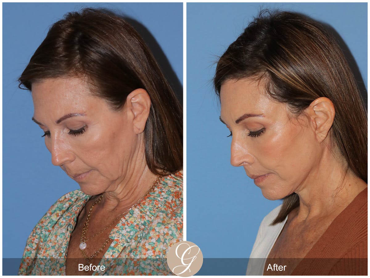 Deep Plane Facelift Before & After Gallery - Patient 136689 - Image 5
