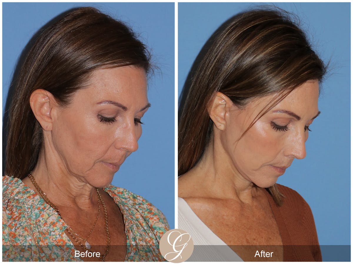 Deep Plane Facelift Before & After Gallery - Patient 136689 - Image 9