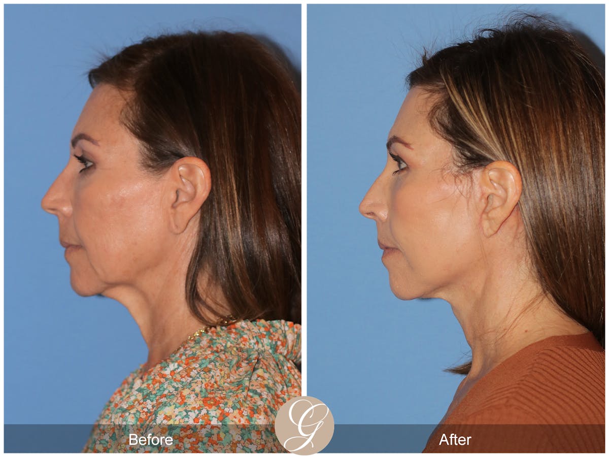 Deep Plane Facelift Before & After Gallery - Patient 136689 - Image 7
