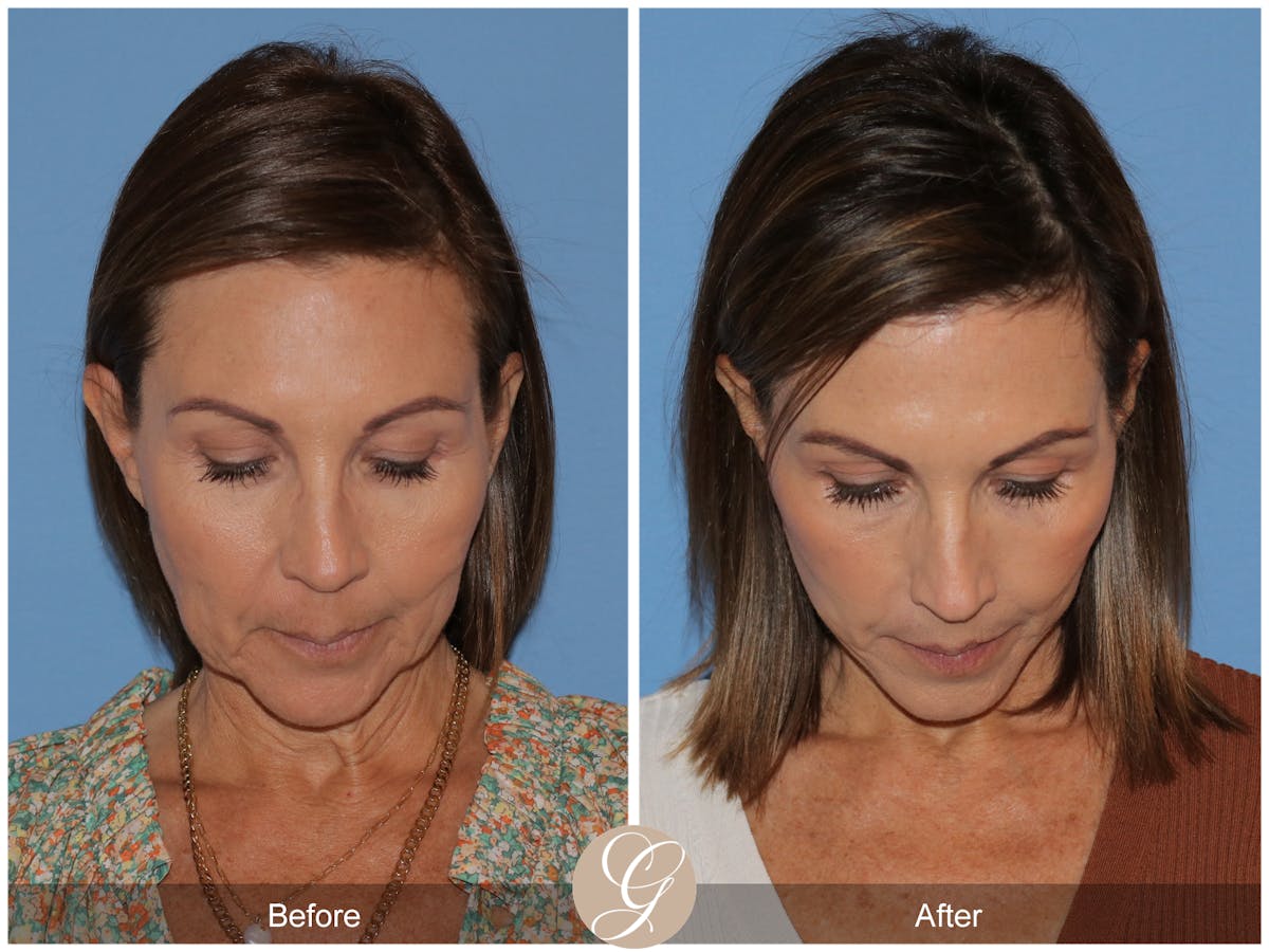 Deep Plane Facelift Before & After Gallery - Patient 136689 - Image 3