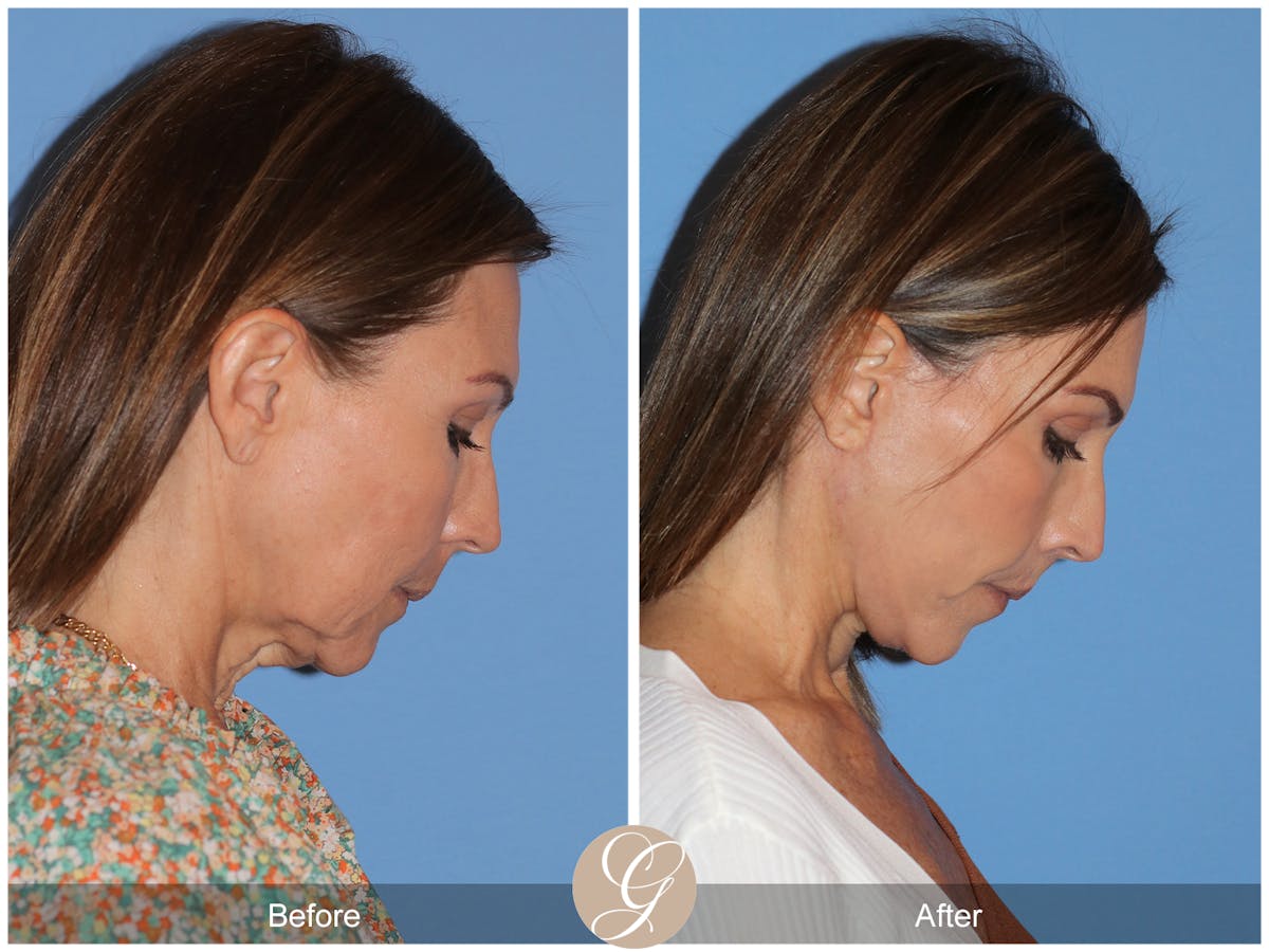 Deep Plane Facelift Before & After Gallery - Patient 136689 - Image 8