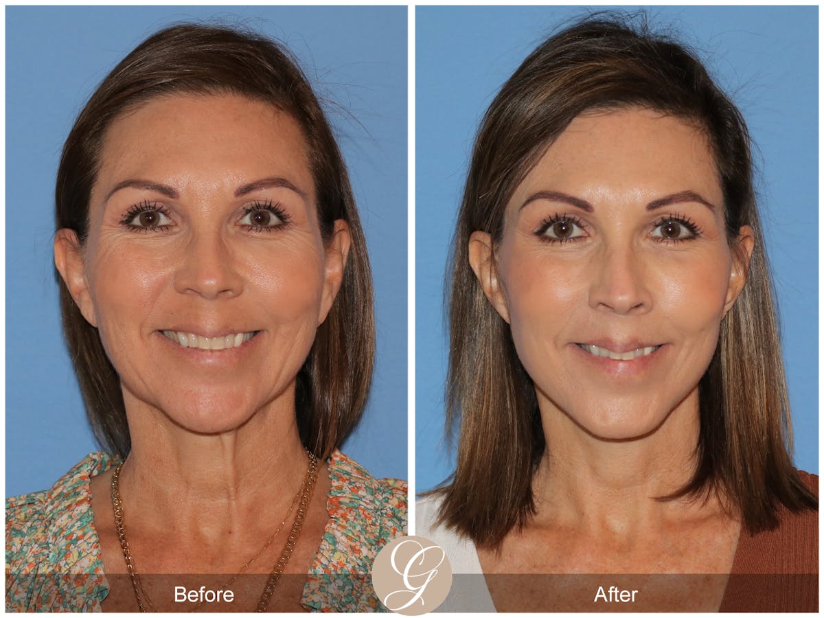 Deep Plane Facelift Before & After Gallery - Patient 136689 - Image 2