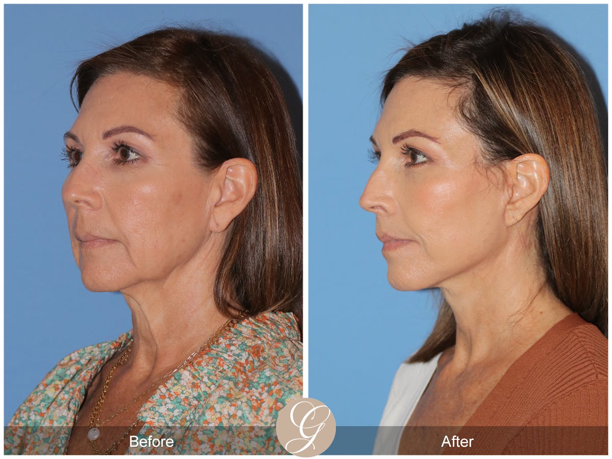 Deep Plane Facelift Before & After Gallery - Patient 136689 - Image 6