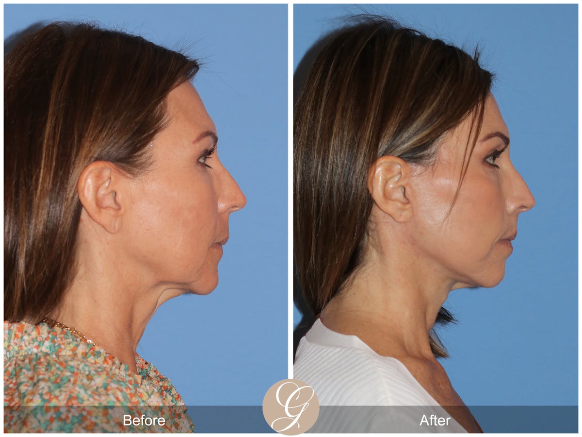 Deep Plane Facelift Before & After Gallery - Patient 136689 - Image 11