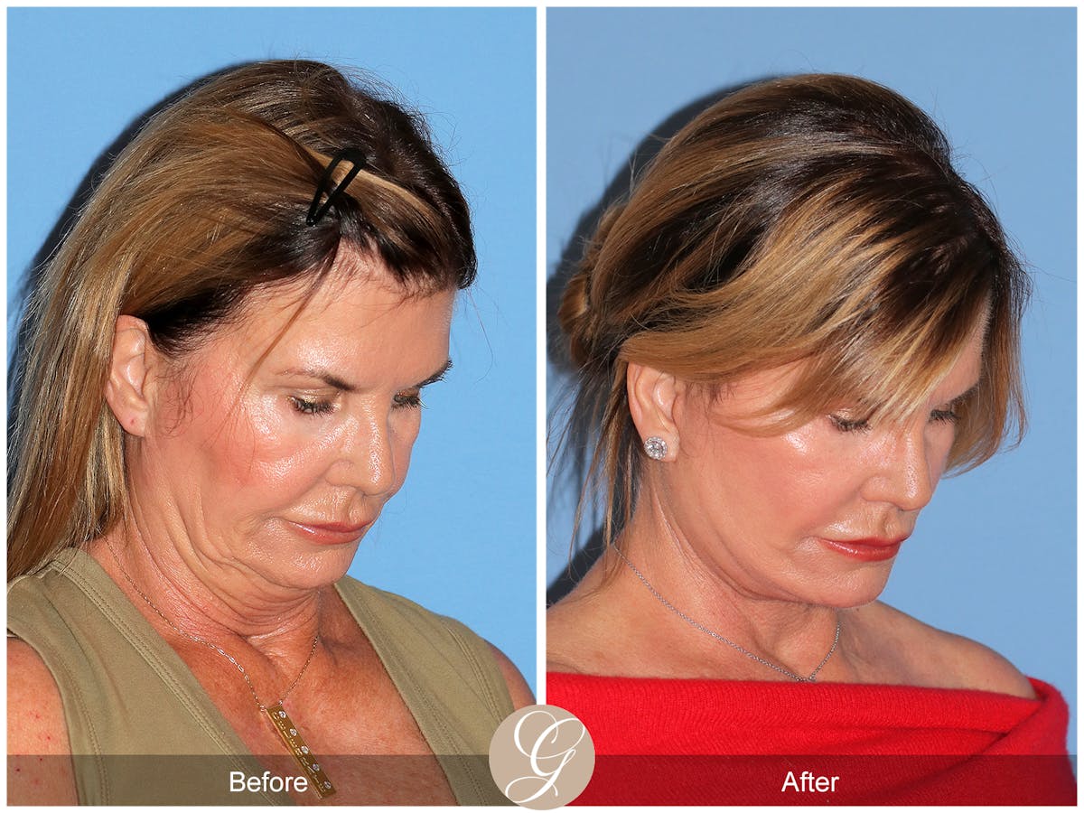 Deep Plane Facelift Before & After Gallery - Patient 238097 - Image 10