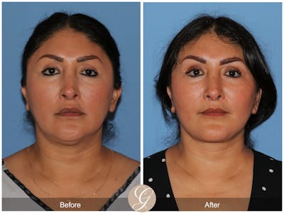Deep Plane Facelift Before & After Gallery - Patient 292666 - Image 1