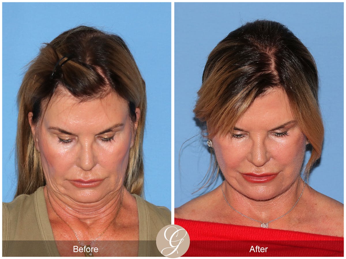 Deep Plane Facelift Before & After Gallery - Patient 238097 - Image 3
