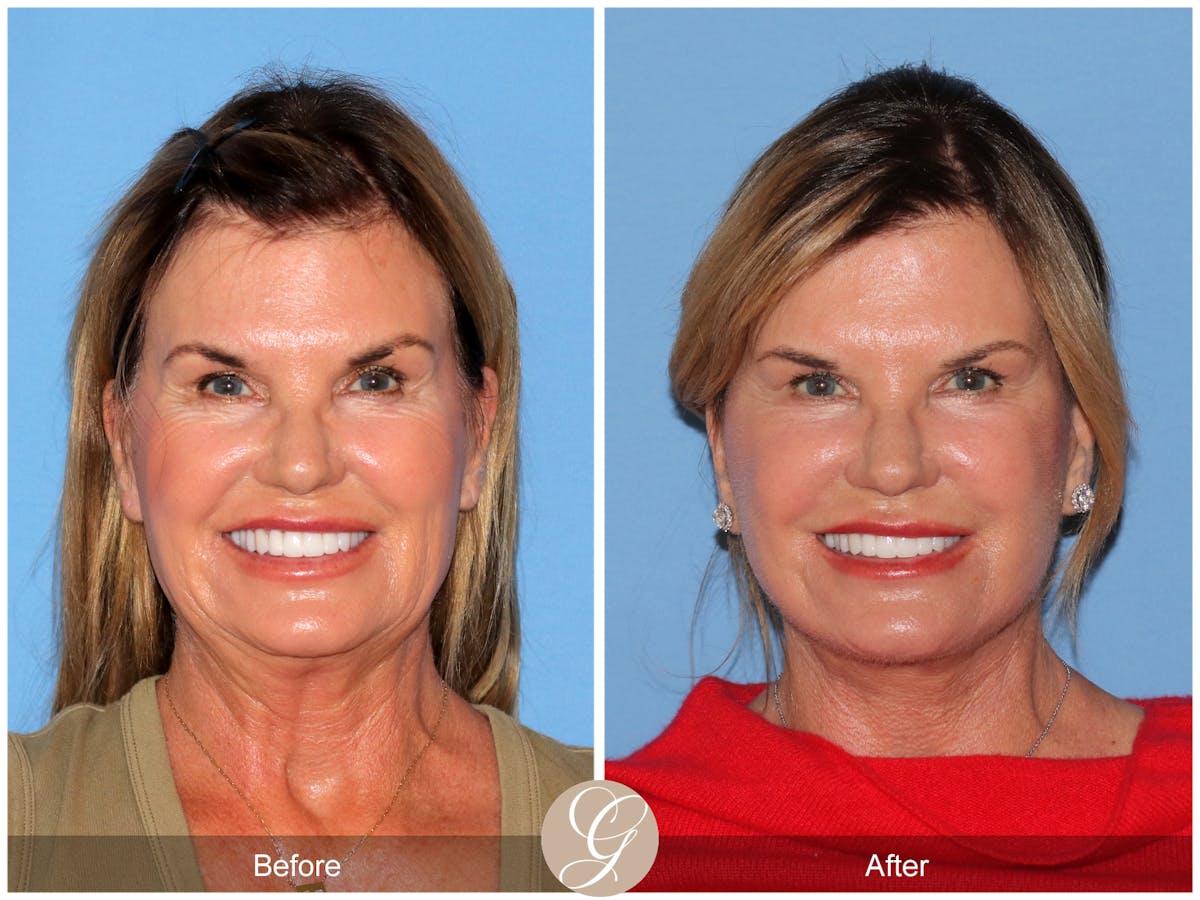 Deep Plane Facelift Before & After Gallery - Patient 238097 - Image 2